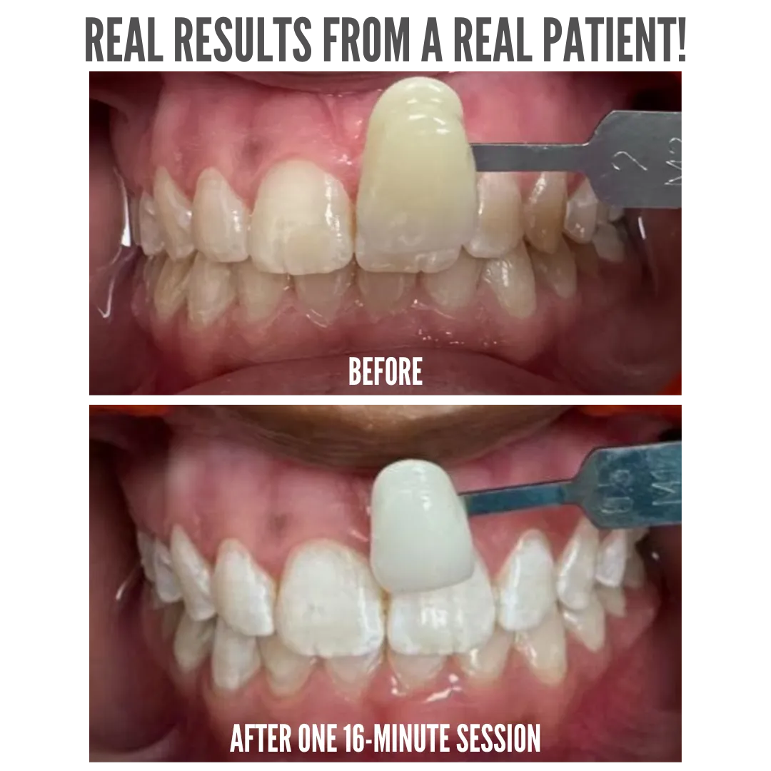 32645 at home teeth whitening glebe