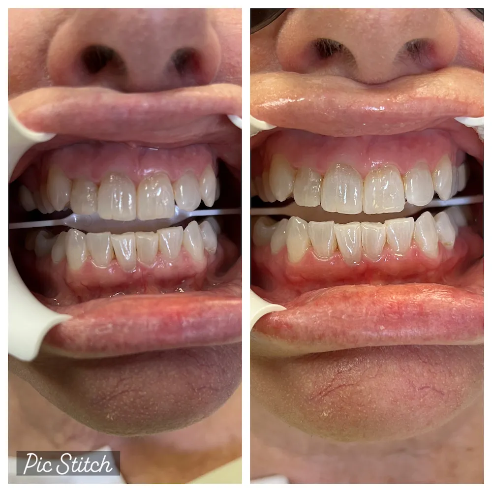 32645 glebe teeth whitening before after