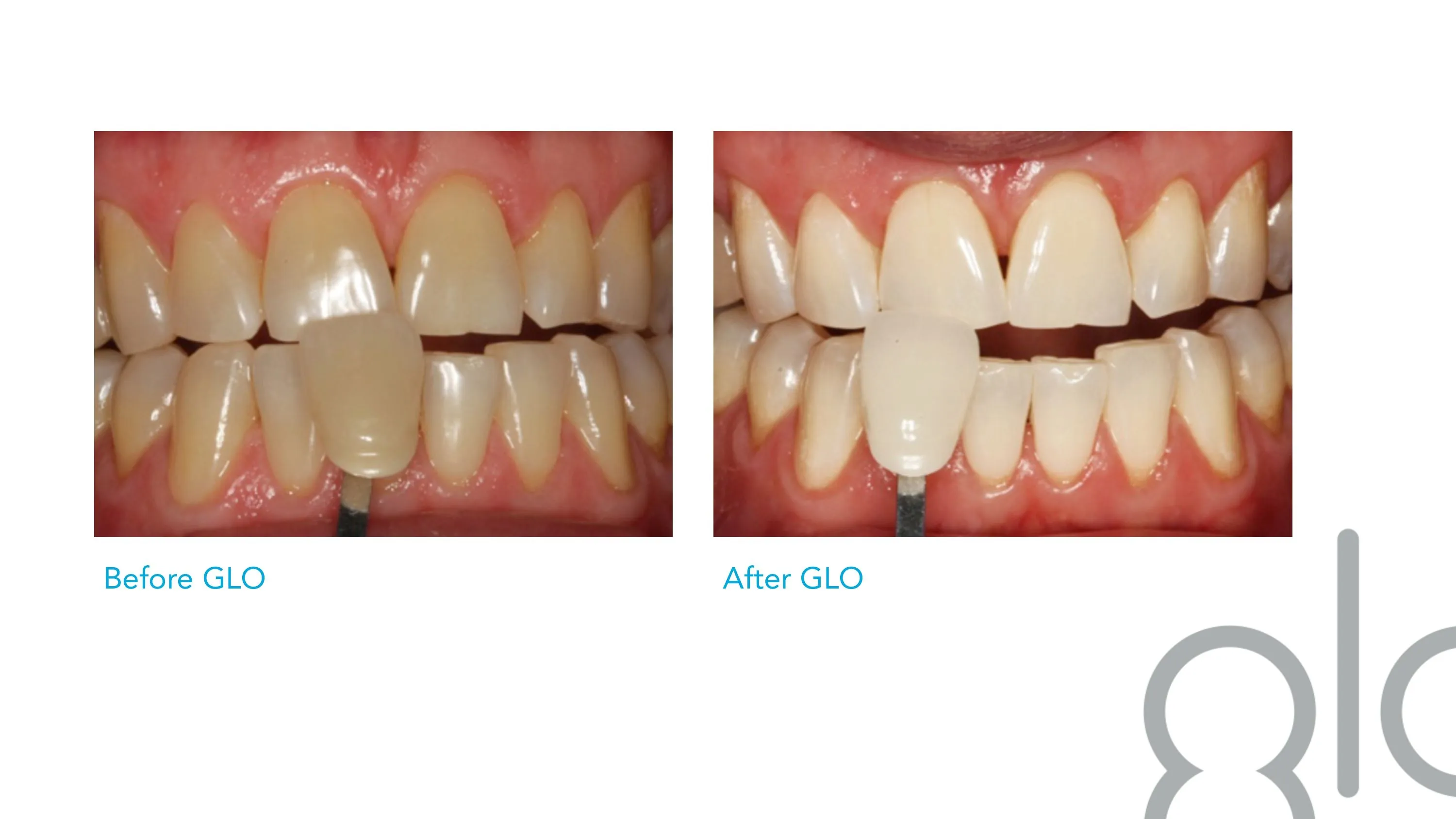 32645 types of teeth whitening glebe