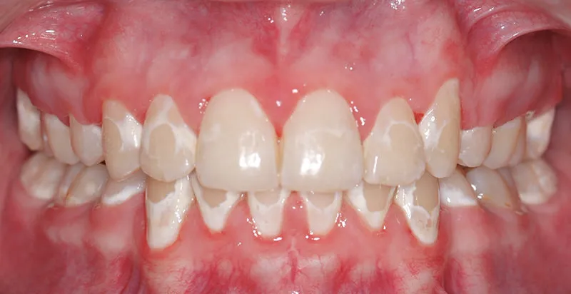 32646 white spots teeth whitening image4