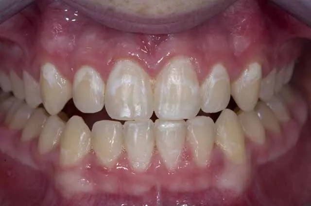 32646 white spots teeth whitening image7