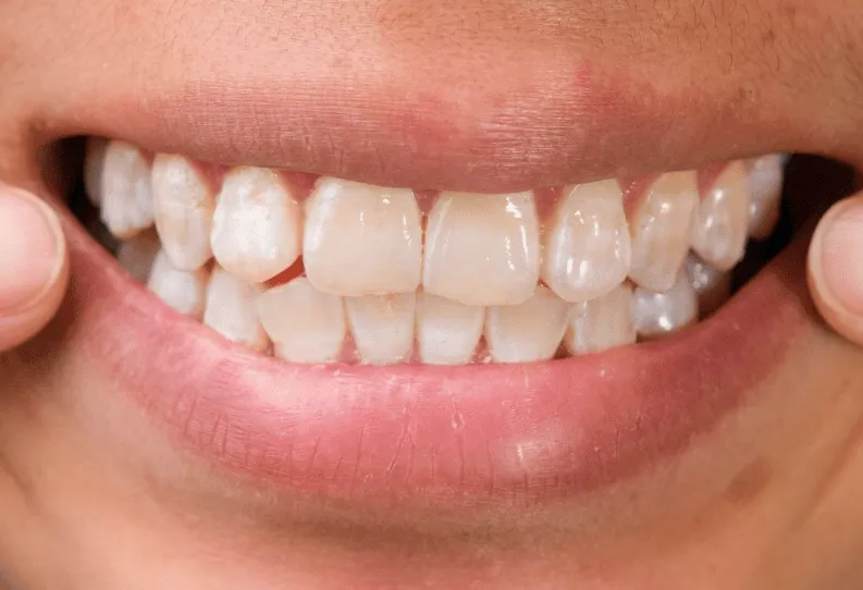 /img/32646-white-spots-teeth-whitening-image8.webp