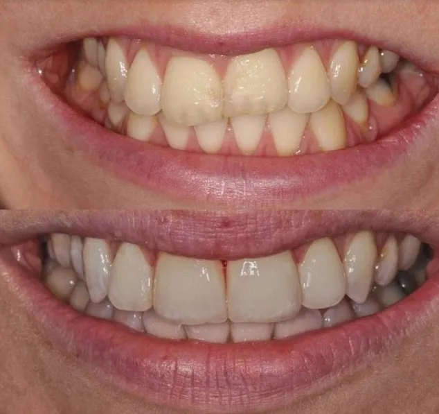 32648 dental veneers