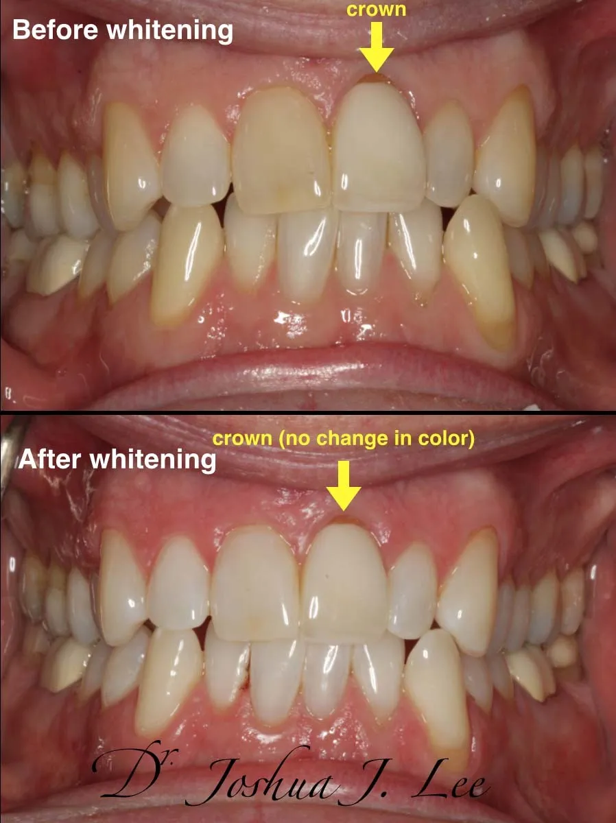 32660 groupon zoom whitening