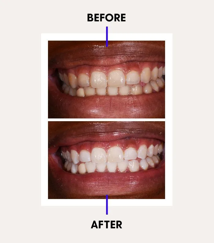 /img/32667-laser-teeth-whitening-consultation.webp