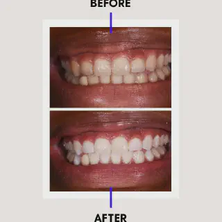 /img/32667-laser-teeth-whitening-consultation.webp