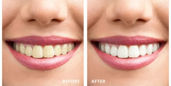 32667 laser teeth whitening results 3