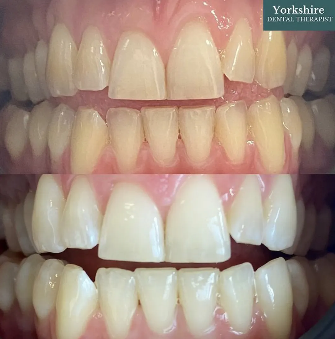 32670 teeth whitening stratford