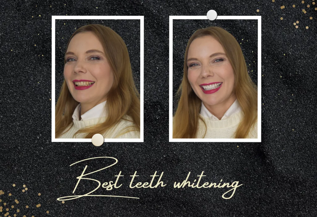 32685 at home teeth whitening