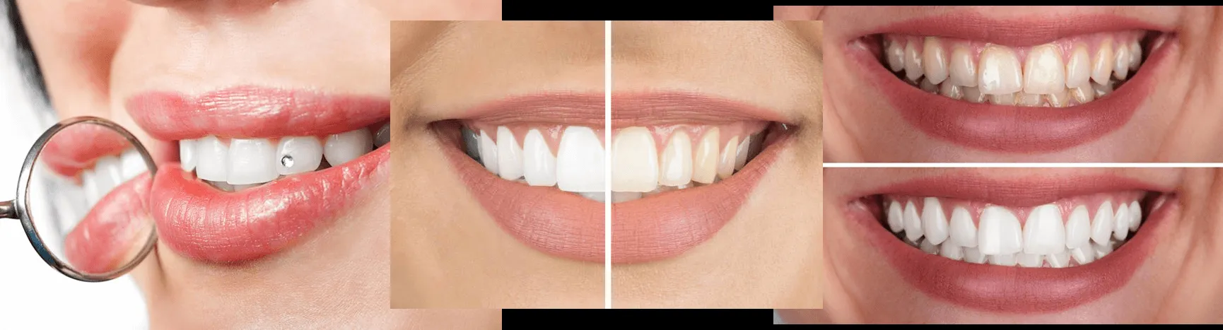 32691 teeth whitening sudbury dentist
