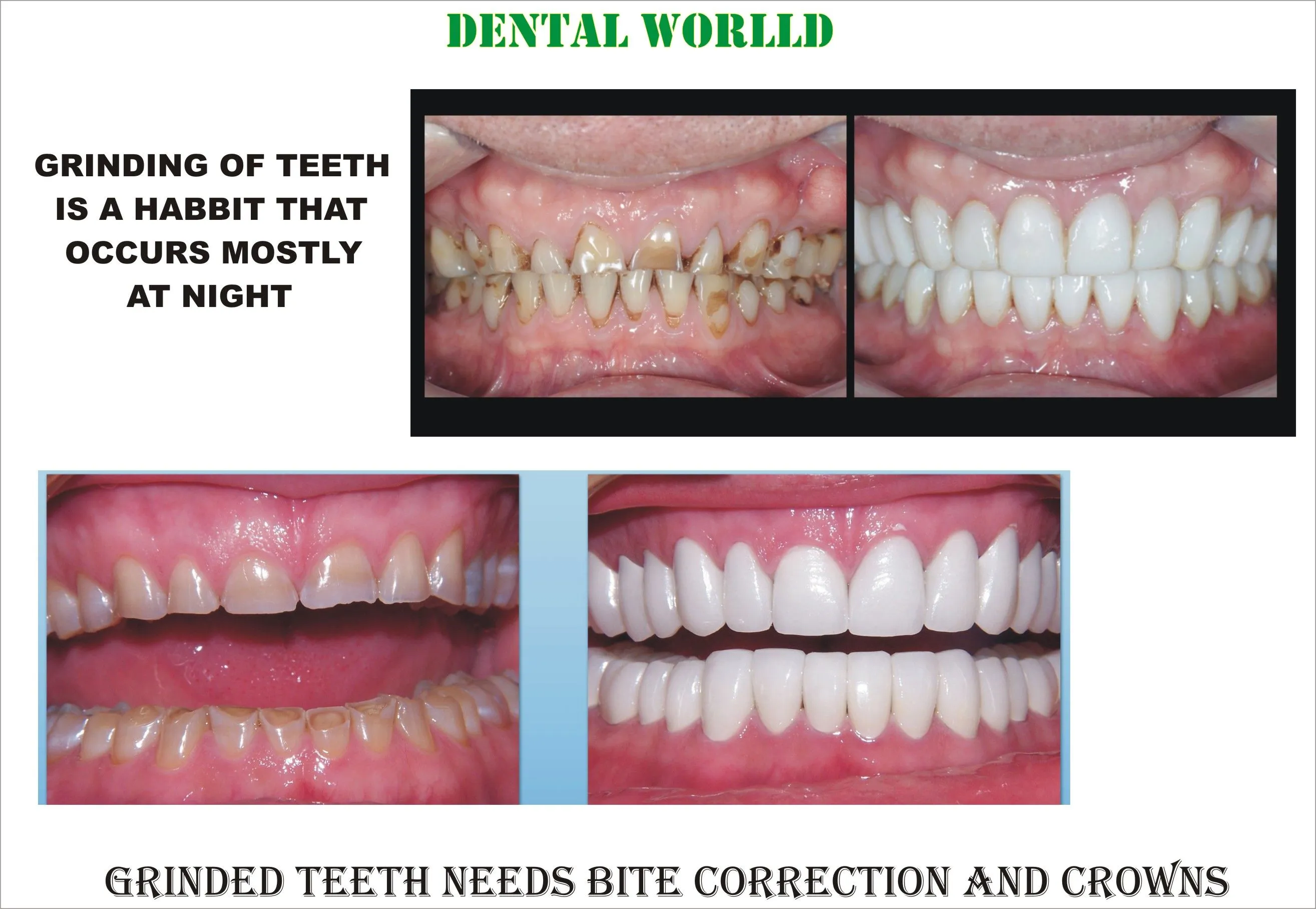 32696 at home whitening