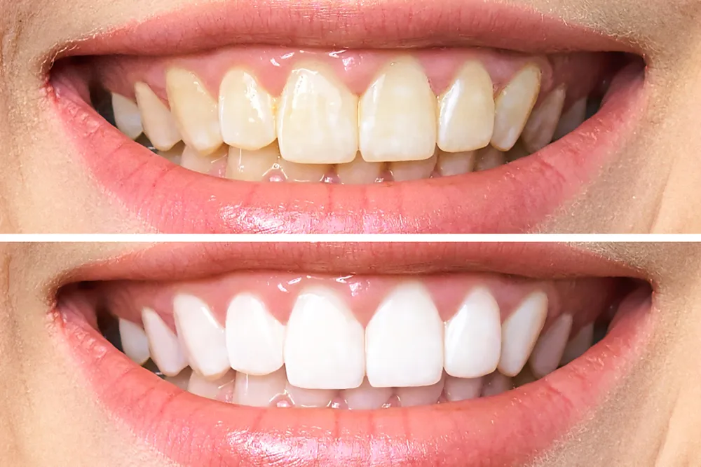 32700 teeth whitening dayton ohio dentist