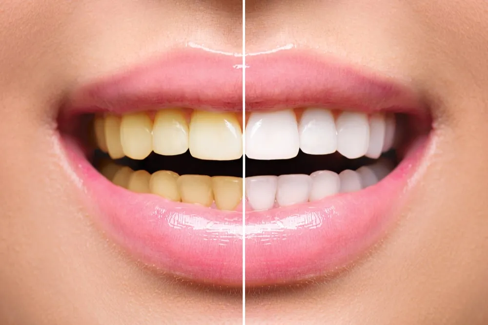 32707 in office teeth whitening
