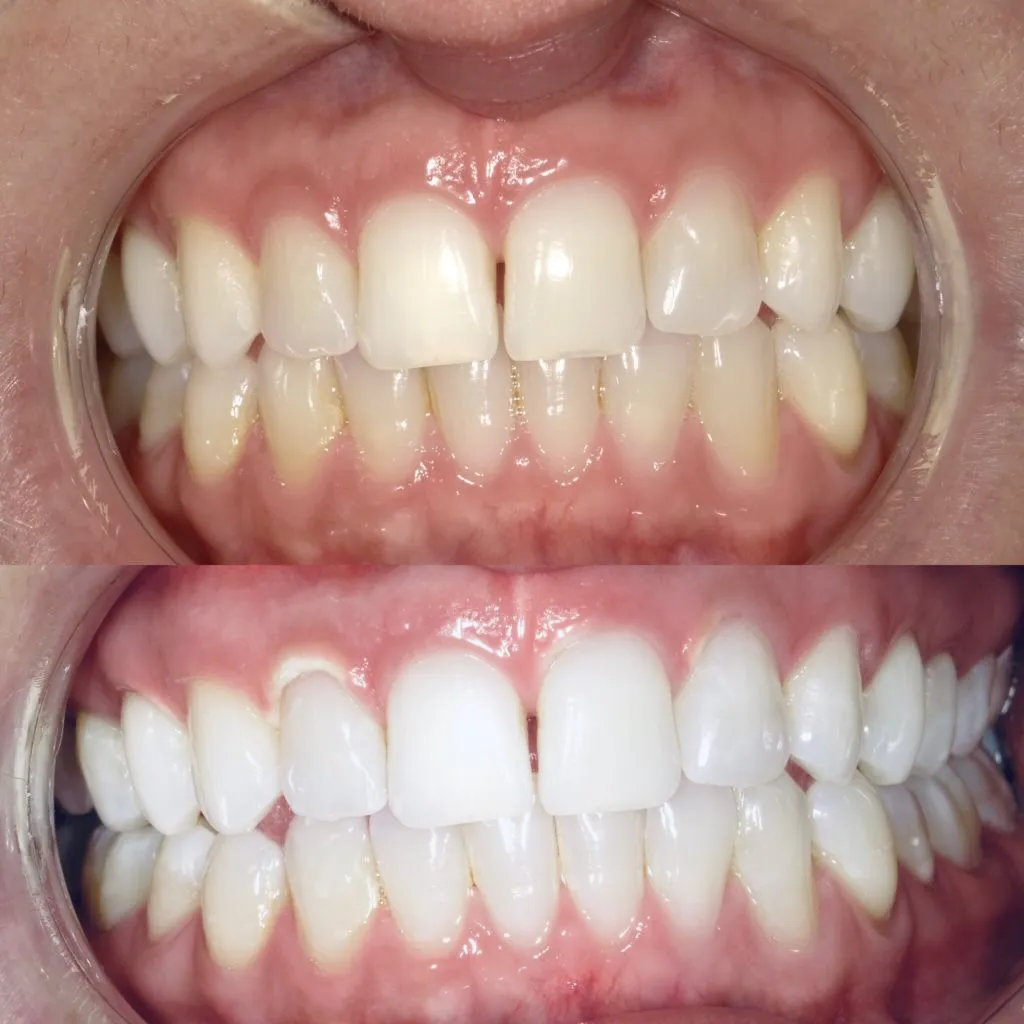 /img/32709-teeth-whitening-alternatives.webp