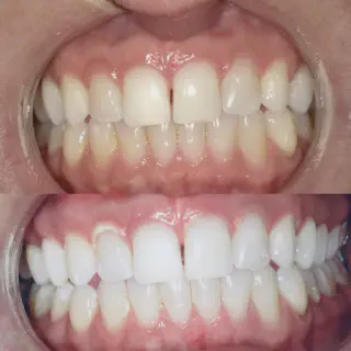 /img/32709-teeth-whitening-alternatives.webp