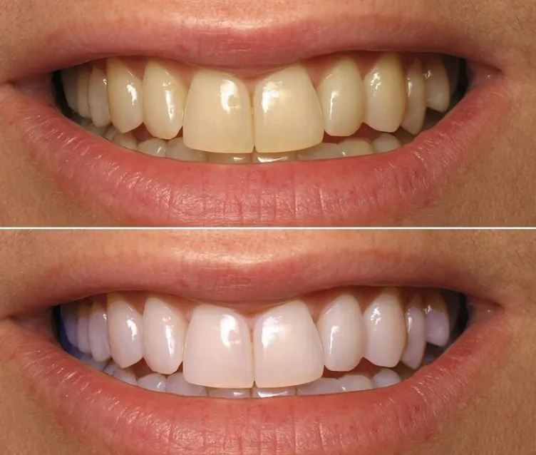 32710 applying whitening strips