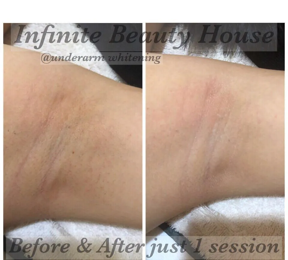 32723 chemical peel underarms