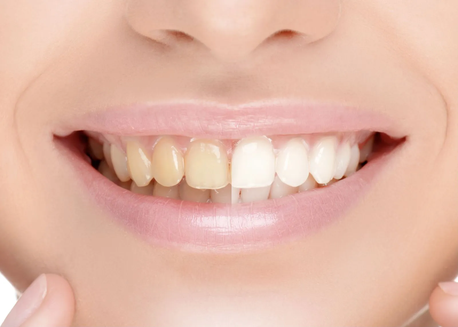 32727 teeth whitening st petersburg fl image4