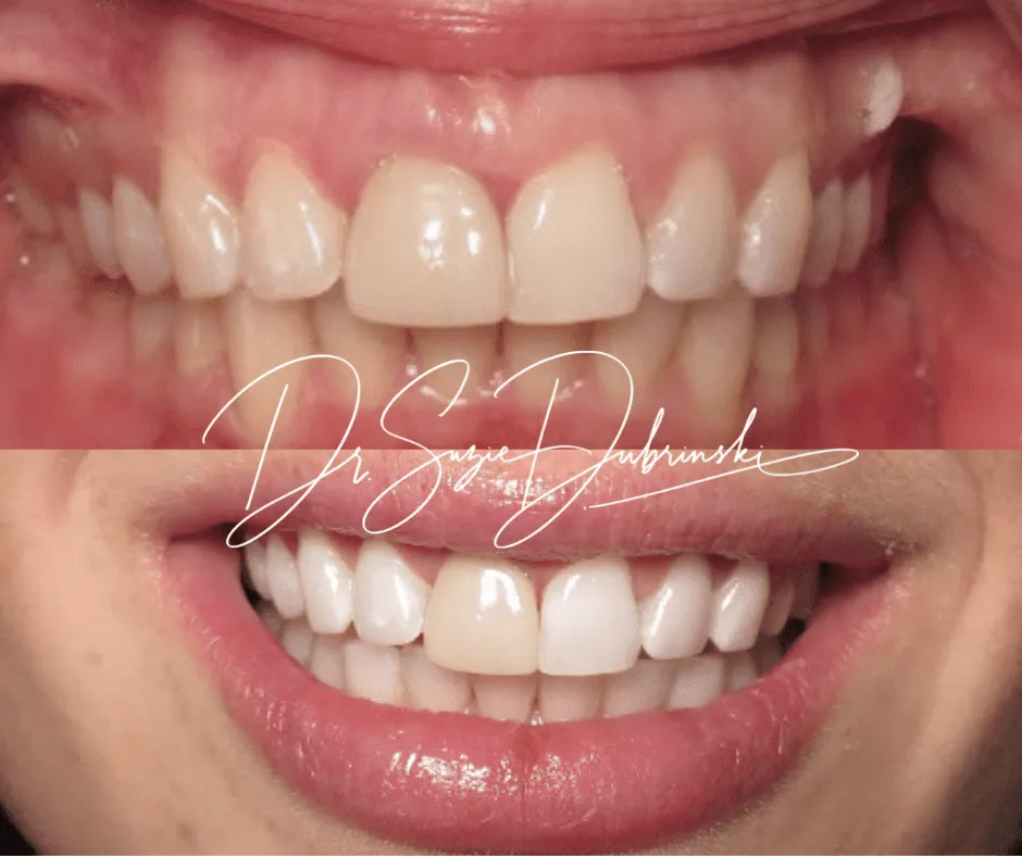 /img/32727-teeth-whitening-st-petersburg-fl-image7.webp