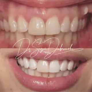 /img/32727-teeth-whitening-st-petersburg-fl-image7.webp