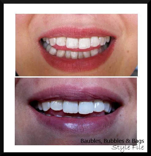 32728 nuova glo teeth whitening usage