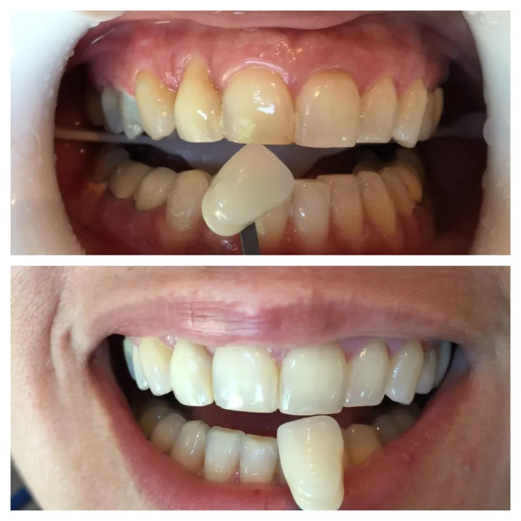32728 sensitive teeth treatment
