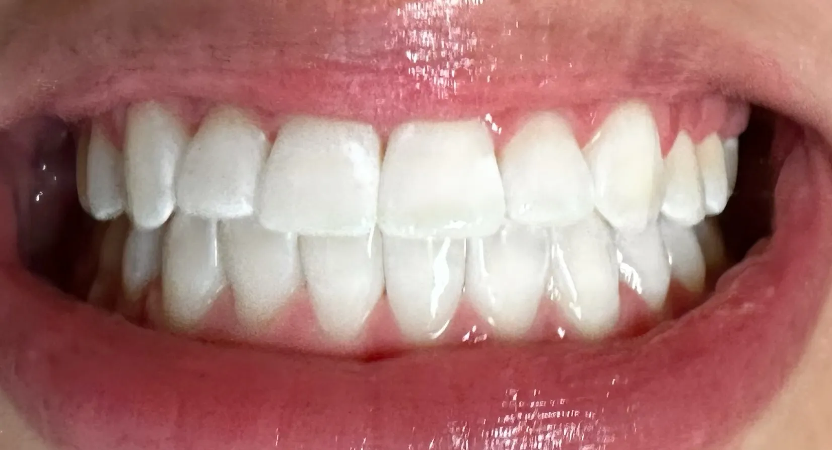 32728 teeth whitening results image
