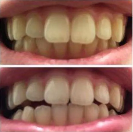 32735 applying whitening cream