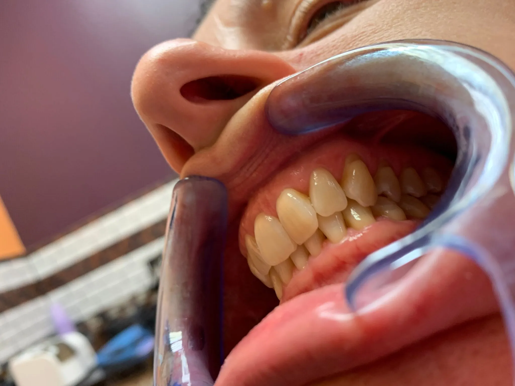 32740 teeth whitening lincoln ne stains