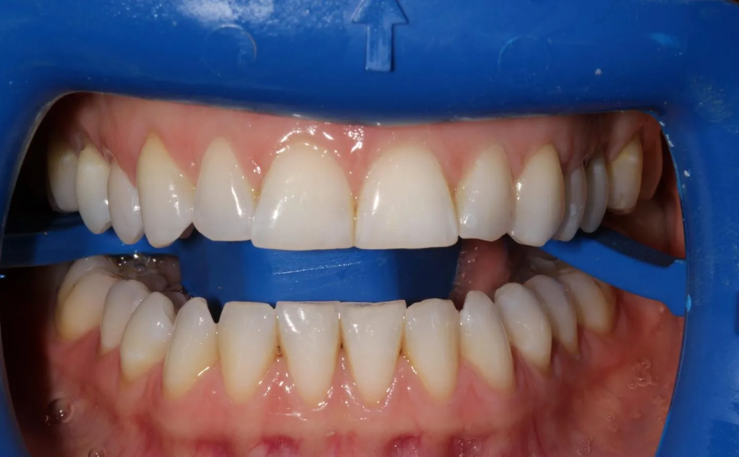 32741 zoom whitening alternatives