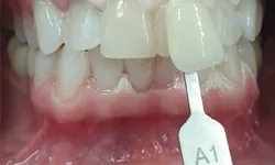 32749 before after whitening