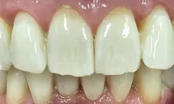 32749 philips tooth whitening products