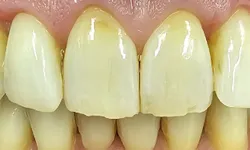 32749 zoom whitening