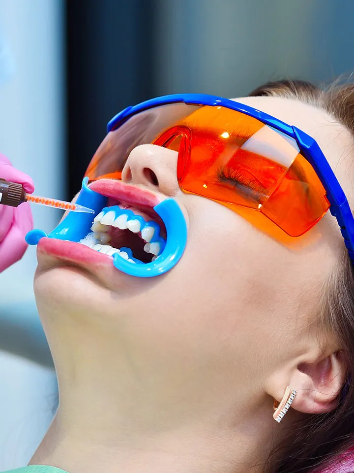 32750 dental whitening treatment