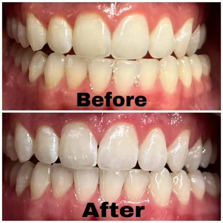 32755 teeth whitening riverside ca image4