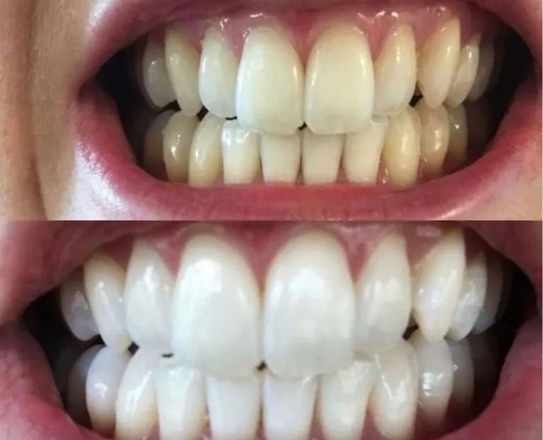 32757 in office whitening