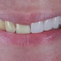 /img/32761-bright-smile-teeth-whitening.webp