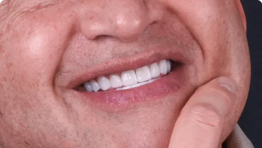 32761 teeth whitening tijuana cost