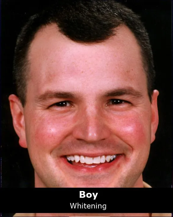 32770 custom whitening trays