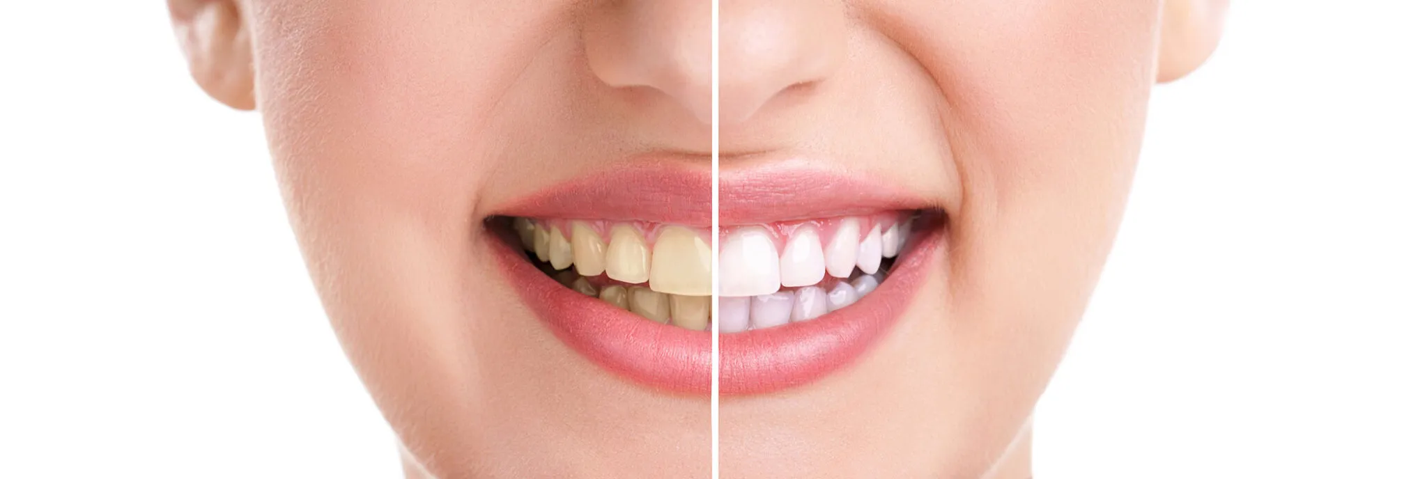 32770 teeth whitening consultation