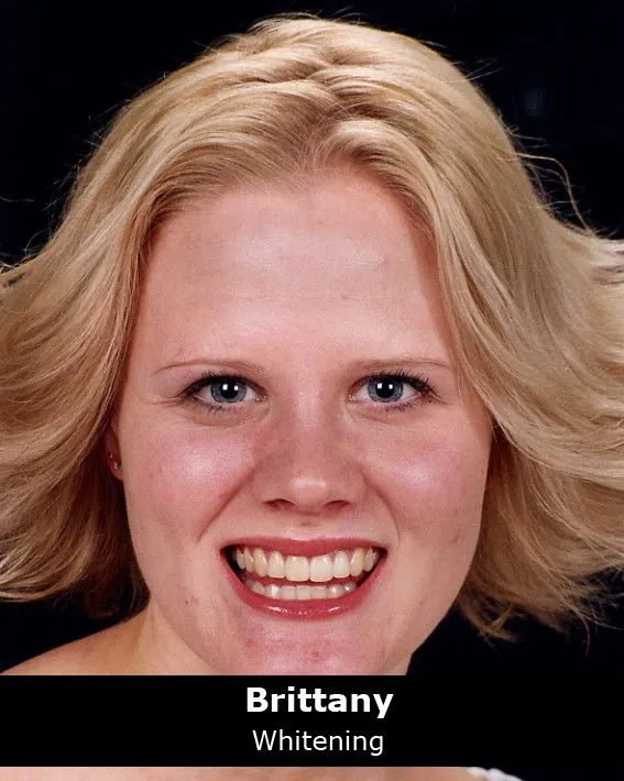 32770 whitening strips