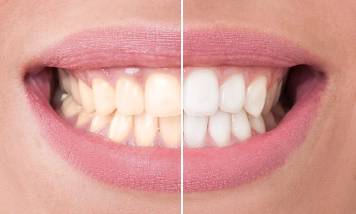 32782 at home teeth whitening