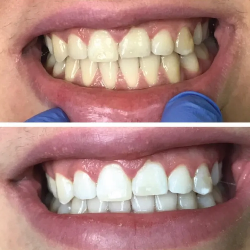 32782 in office teeth whitening