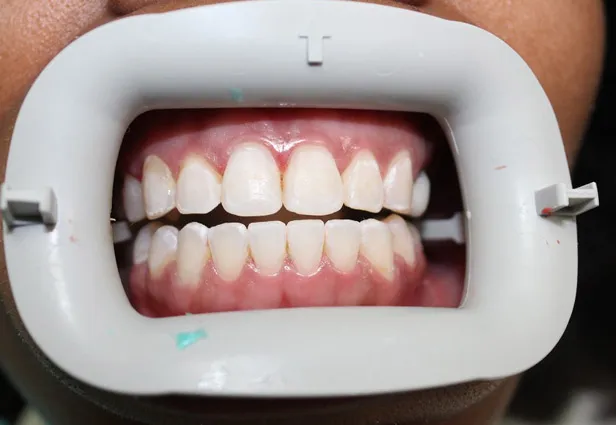 32782 teeth whitening aftercare