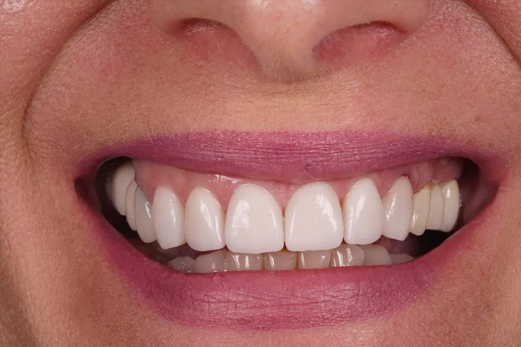 32782 types of teeth whitening