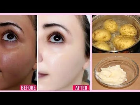 32786 sunburn relief potato