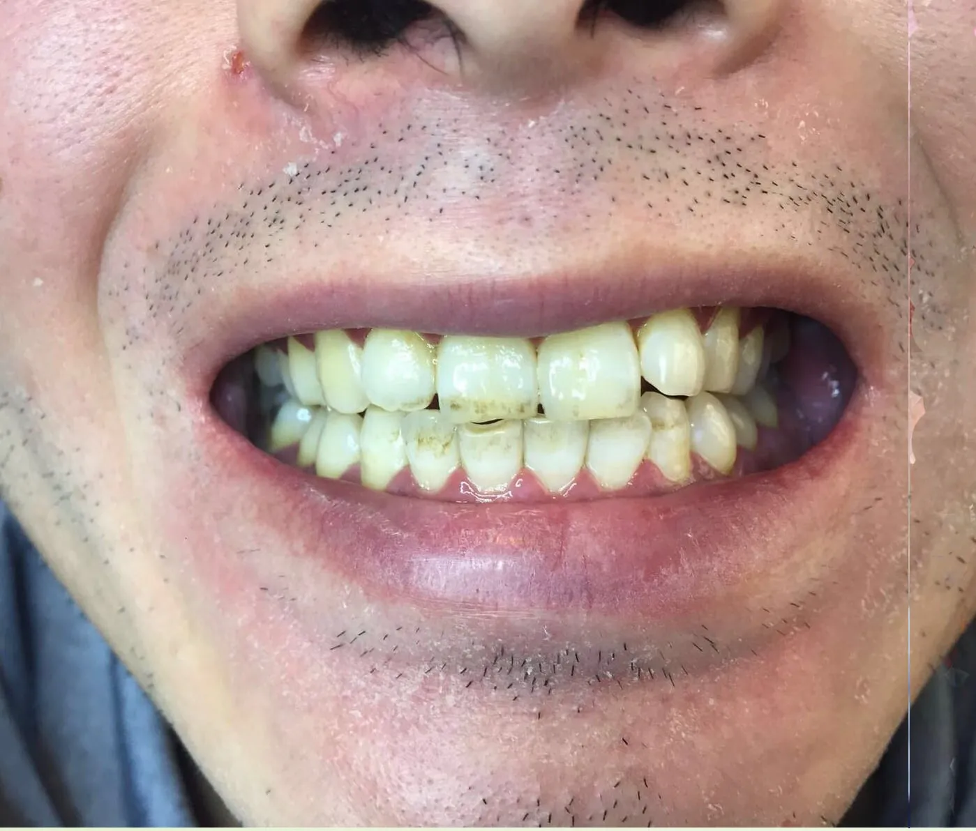 32795 professional teeth whitening