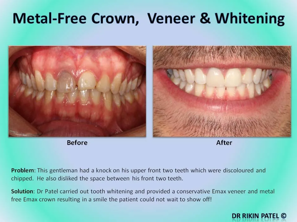 32806 teeth whitening cost comparison
