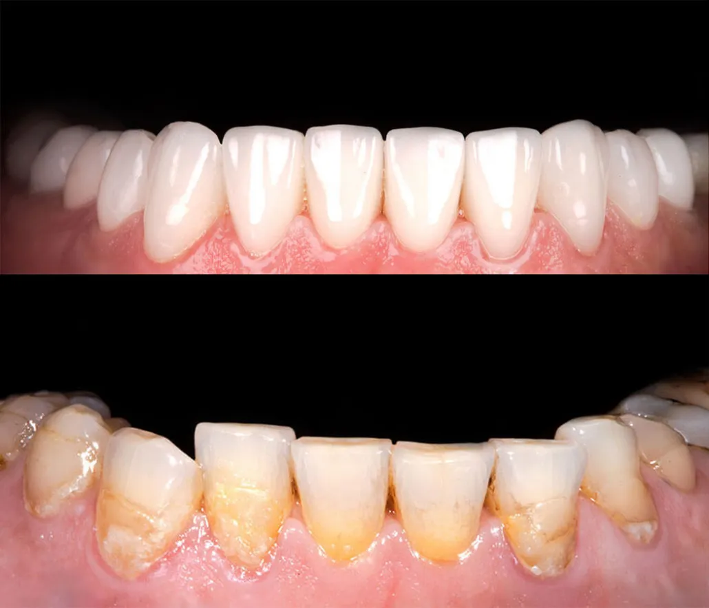 32806 teeth whitening vs veneers banner