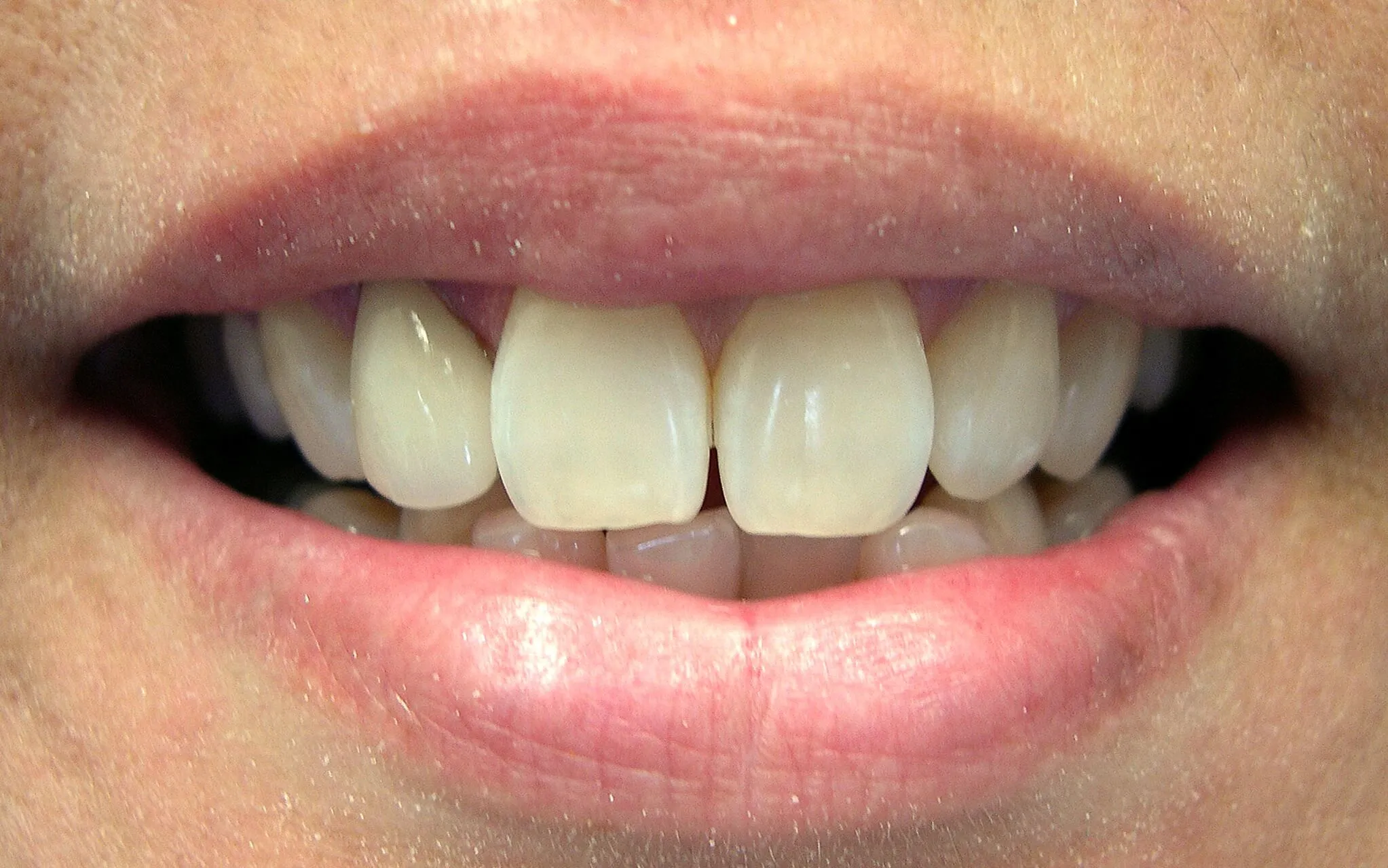 /img/32816-teeth-whitening-aftercare.webp